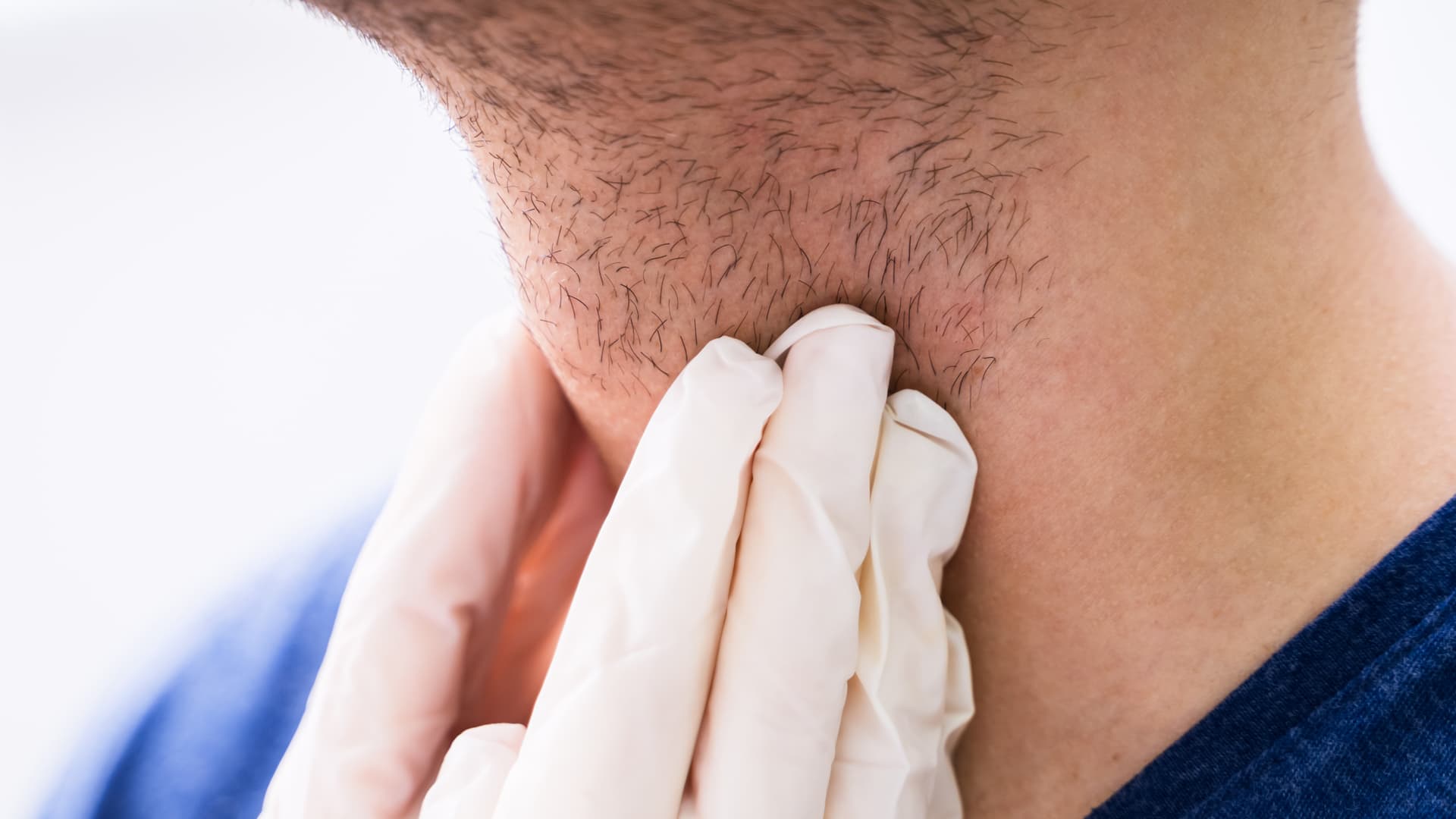 Adénopathies cervicales | Chirurgie d'ablation des ganglions du cou