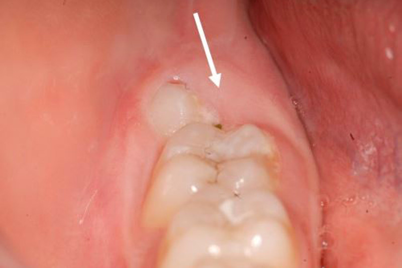 Avulsions des dents de sagesse - Dr Bandini