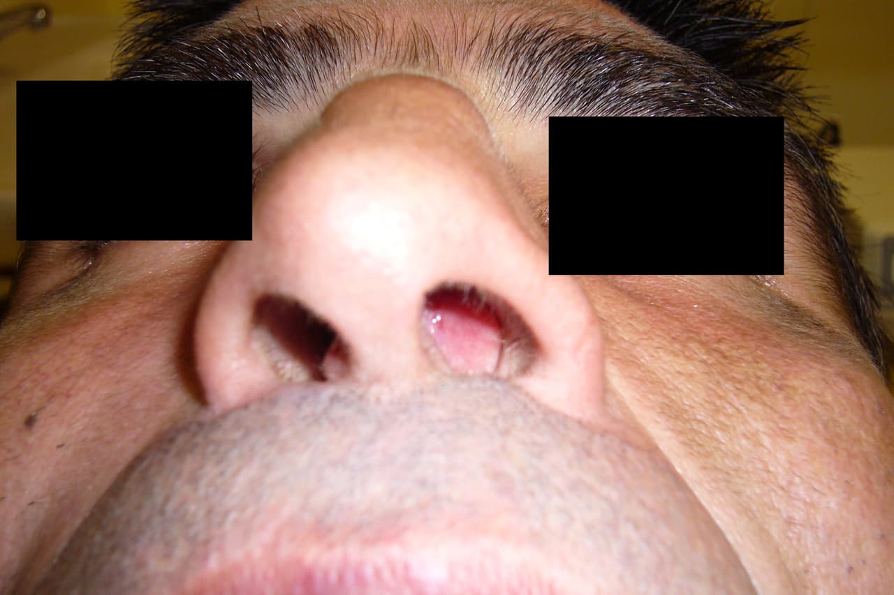 Septoplastie ou chirurgie de la cloison nasale | Indications ...