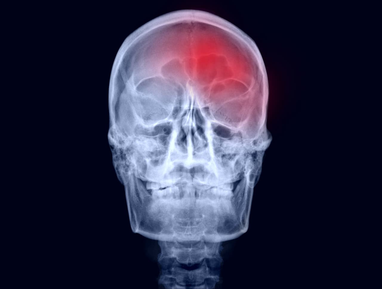 Sinusotomie frontale | Ouverture du sinus frontal par voie endonasale