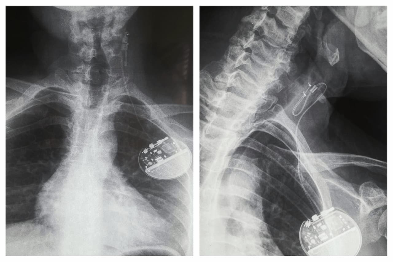 Radiographie d'un implant du nerf vague réalisée par le Dr Delagranda
