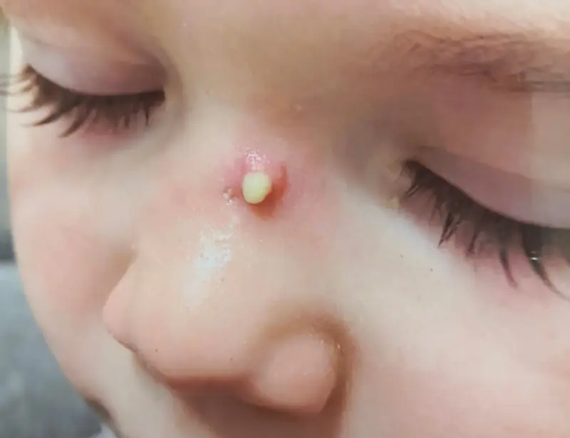 Exemple de malformation embryonnaire : kyste situé sur le dos du nez