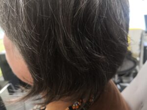 Prothèse auditive à ancrage osseux Prothèse par implant ostéointégré